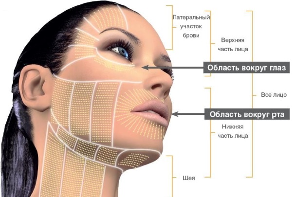 Levantamento SMAS - limpeza ultrassônica do rosto. Características do procedimento, indicações, contra-indicações, efeito esperado, foto