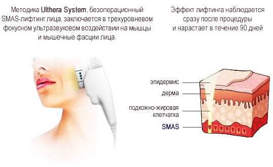 SMAS løft - ultralyd ansiktsrengjøring. Funksjoner av prosedyren, indikasjoner, kontraindikasjoner, forventet effekt, foto