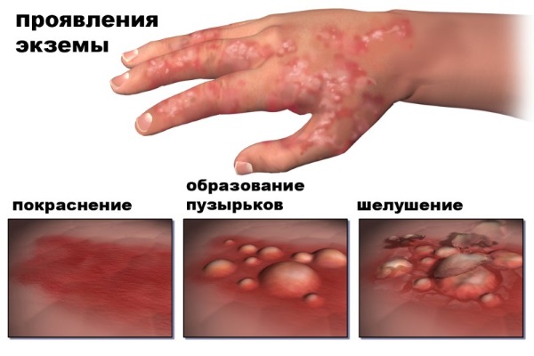 Risse an den Fingern - Gründe, Foto. Behandlung zu Hause mit Volksheilmitteln, medizinischen Salben
