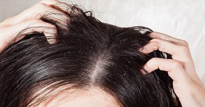 Vypadávání vlasů u žen - jak zastavit, co dělat: šampony, oleje, masky, komplexy vitamínů
