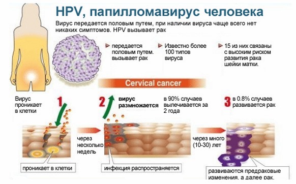 HPV hos kvinder - hvad er det, symptomer, typer, hvordan overføres det, behandling af humant papillomavirus i gynækologi