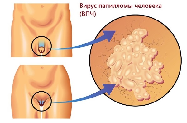 HPV hos kvinder - hvad er det, symptomer, typer, hvordan overføres det, behandling af humant papillomavirus i gynækologi