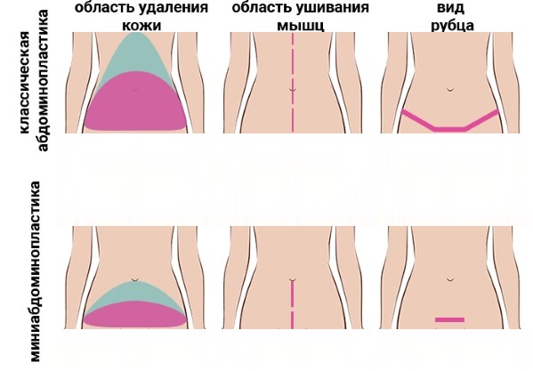 Abdominoplastia de abdômen. O que é esta operação, como se faz, antes e depois das fotos, indicações e contra-indicações, consequências