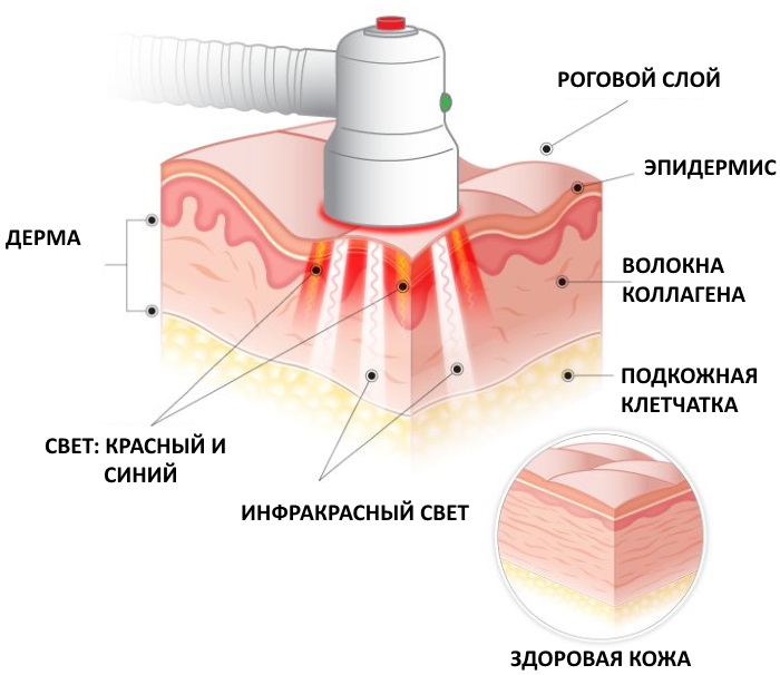 Photodynamic therapy in cosmetology. How is the procedure, indications and effectiveness