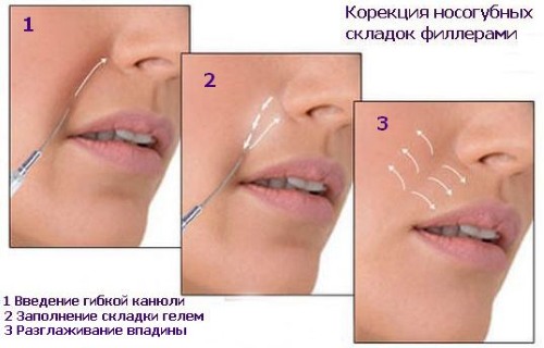 Hijaluronska kiselina za lice u injekcijama za injekcije. Koji su lijekovi bolji, kako koristiti, kako djeluju, rezultati, prije i poslije fotografija, cijena u ljekarni