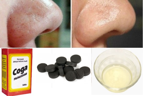 Face mask with soda for wrinkles, acne, blackheads, age spots. Recipes and home use