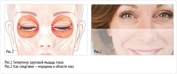 Botoks enjeksiyonları için kozmetolojide insan yüz kaslarının anatomisi. Latince ve Rusça açıklamalar ve fotoğraflar içeren şemalar