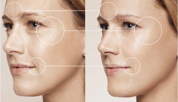 Žmogaus veido raumenų anatomija kosmetologijoje, atliekant botokso injekcijas. Schemos su aprašymais ir nuotraukomis lotynų ir rusų kalbomis