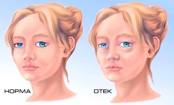 Swelling of the face in women. Causes and treatment with folk remedies, pills, masks, recommended products, how to relieve puffiness in the morning