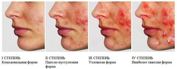 Bőr alatti pattanások az arcon. A megszabadulás okai. Gyors kezelés népi gyógymódokkal, kenőcsökkel, otthoni gyógyszerekkel