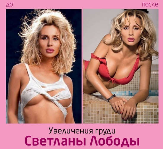 Svetlana Loboda abans i després de la cirurgia plàstica. Foto de cara, nas, llavis, pit. Biografia del cantant, edat, paràmetres de forma, alçada i pes