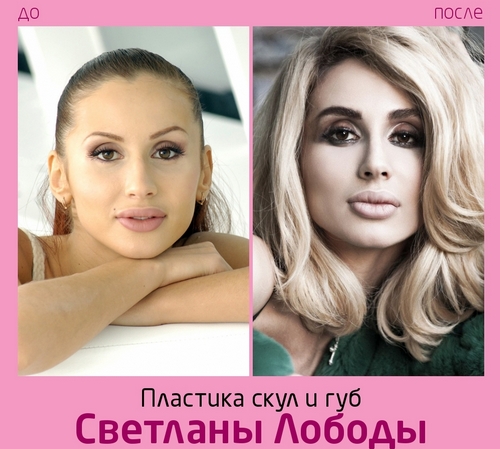 Svetlana Loboda πριν και μετά την πλαστική χειρουργική. Φωτογραφία προσώπου, μύτης, χειλιών, στήθους. Βιογραφία τραγουδιστή, ηλικία, παράμετροι σχήματος, ύψος και βάρος