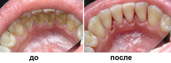 Berus gigi ultrasonik. Kebaikan dan keburukan, ulasan doktor, penilaian terbaik dan kontraindikasi