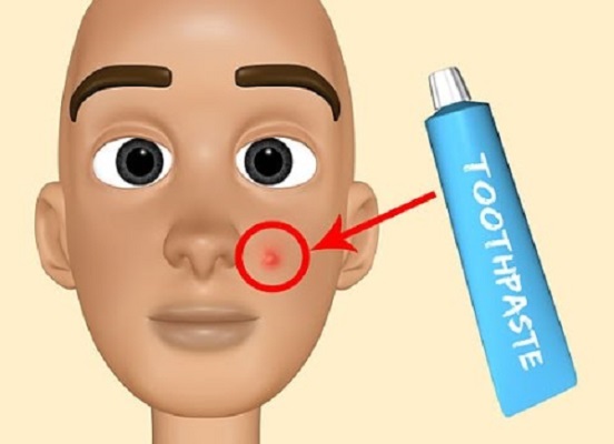 Comment appliquer du dentifrice pour l'acné sur le visage. Recette de préparation et d'utilisation, photo