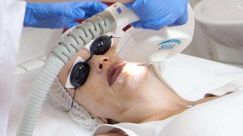 Geräte zur Entfernung von Altersflecken, Narben, Tätowierungen auf Gesicht und Körperhaut. Laser, Fraxel, Elos, M22. Bewertung und Bewertungen