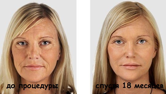 Biorenforcement facial - ce que c'est, les types, comment faire la procédure avec de l'acide hyaluronique, des fils, des charges, des médicaments. Photos et conséquences