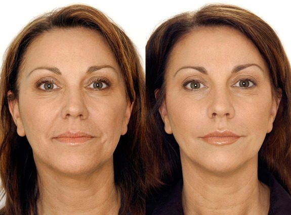 Czym jest biorewitalizacja twarzy, czym różni się od mezoterapii, wypełniacze. Wskazania, przeciwwskazania, konsekwencje. Zdjęcie