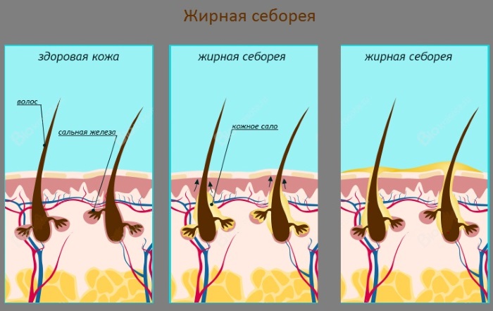 ماذا تفعل إذا كان الشعر الدهني في الجذور والقشرة يجف في الأطراف ويسقط - الأسباب. كيفية التعامل - نصيحة من عالم الشعر