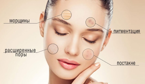 Ferul peeling - what is it, how is it done, acids, protocol of the Medderma procedure, reviews, photos and results