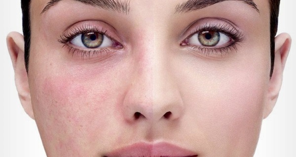 Galvanoplastie en cosmétologie - qu'est-ce que c'est, comment les procédures sont effectuées pour la peau autour des yeux, du visage et du corps, avantages et inconvénients, avantages. Appareil à usage domestique. Une photo