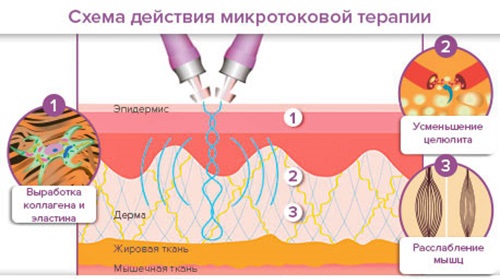 الطلاء الكهربائي في التجميل - ما هو ، كيف تتم الإجراءات للبشرة حول العينين ، الوجه والجسم ، الإيجابيات والسلبيات ، الفوائد. جهاز للاستخدام المنزلي. صورة