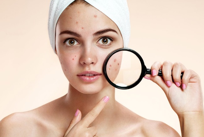 Hoe u snel acne en mee-eters in het gezicht kunt verwijderen. Dieet, folkremedies, medicinale zalven, crèmes