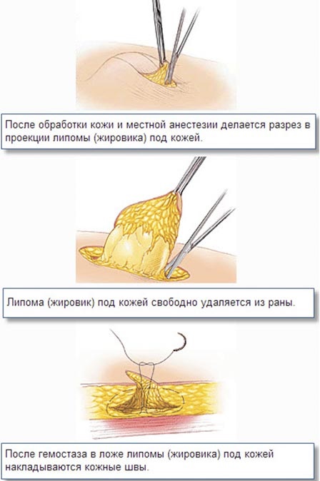 วิธีกำจัดเหวินบนใบหน้า. การรักษาขี้ผึ้งครีมยาสูตรพื้นบ้านและการเยียวยา