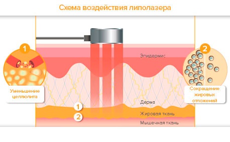 Laserska lipoliza - što je to, kako se to radi, indikacije i kontraindikacije. Recenzije liječnika i pacijenata, fotografije