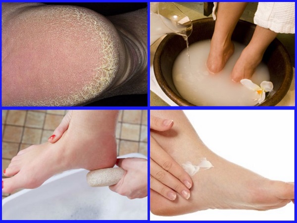 Rawatan kulit pada tumit dari retakan di rumah. Resipi rakyat, ubat-ubatan, salap, ubat-ubatan
