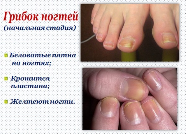 Traitement des ongles sur les mains et les pieds après vernis gel, extension. Recettes folkloriques, produits pharmaceutiques, système IBX
