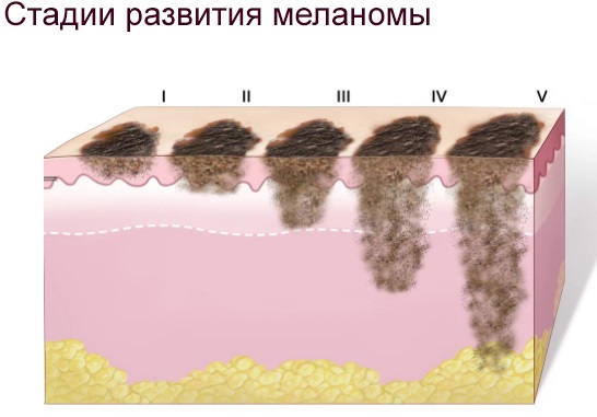 Plaukų šalinimas lazeriu. Kas geriau: diodas arba aleksandrito lazeris veidui, kūnui, bikinio zonai. Kontraindikacijos ir pasekmės, rezultatai, nuotraukos