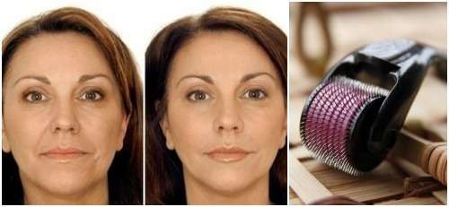 Мезокутер за лице: који одабрати, како га користити код куће, упутства, фотографије пре и после