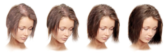 Minoxidil para el cabello: cómo funciona, efectividad, fotos de antes y después, reseñas. Cómo aplicar en mujeres y hombres, efectos secundarios, posibles daños. Precio y opiniones