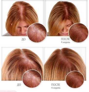 Minoxidil per als cabells: com funciona, efectivitat, fotos abans i després, ressenyes. Com aplicar-se a dones i homes, efectes secundaris, possibles danys. Preu i ressenyes