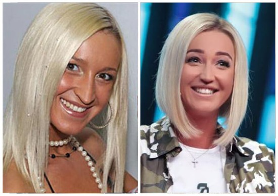 Olga Buzova - ảnh trước và sau khi phẫu thuật thẩm mỹ mũi, môi, gò má. Tôi đã giảm cân như thế nào, tôi đã phẫu thuật thẩm mỹ gì