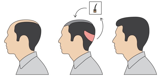 Métodos de trasplante de cabello de cuero cabelludo para hombres y mujeres. Cómo va la operación, HFE, precios de la clínica, resultados, fotos