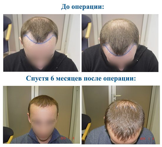 Fejbőr hajátültetési módszerek férfiaknak és nőknek. Hogyan halad a műtét, HFE, klinika árak, eredmények, fotók