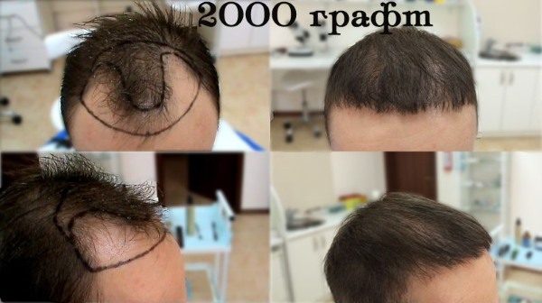 Phương pháp cấy tóc da đầu cho nam và nữ. Cuộc mổ diễn ra như thế nào, HFE, giá phòng khám, kết quả, hình ảnh