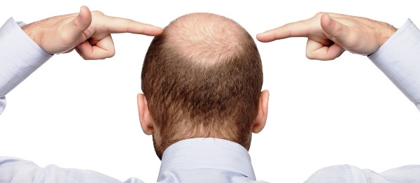 Mètodes de trasplantament de cabell cabellut per a homes i dones. Com va l'operació, HFE, preus de la clínica, resultats, fotos
