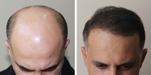 Mètodes de trasplantament de cabell cabellut per a homes i dones. Com va l'operació, HFE, preus de la clínica, resultats, fotos