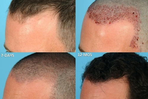 Fejbőr hajátültetési módszerek férfiaknak és nőknek. Hogyan halad a műtét, HFE, klinika árak, eredmények, fotók