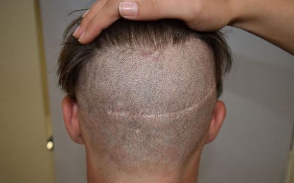 Métodos de trasplante de cabello de cuero cabelludo para hombres y mujeres. Cómo va la operación, HFE, precios de la clínica, resultados, fotos