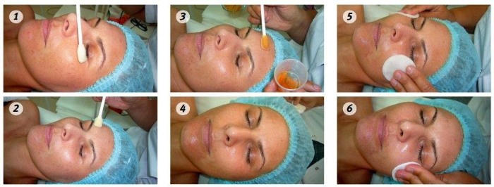 Benefits and harms of face peeling: chemical, fruit acids, glycolic, hardware, retinol, Jessner, succinic acid, with calcium