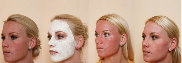 Benefits and harms of face peeling: chemical, fruit acids, glycolic, hardware, retinol, Jessner, succinic acid, with calcium