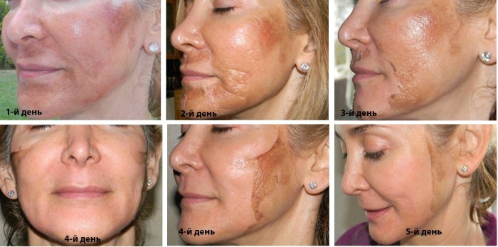 Výhody a poškození peelingu na obličej: chemikálie, ovocné kyseliny, glykolová, hardware, retinol, Jessner, kyselina jantarová, s vápníkem