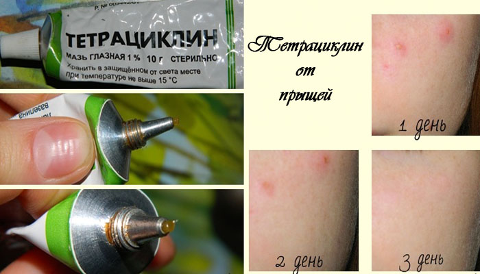 Tetracycline pamahid para sa acne sa mukha. Mga tagubilin para sa paggamit, mga larawan, repasuhin, presyo
