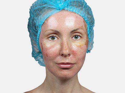 Penjagaan kulit setelah pengelupasan wajah: laser, kimia, buah, glikolik, perkakasan, retinol, Jessner, kuning, TCA, bodyag, asid salisilat