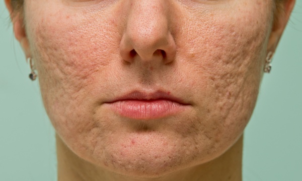 Njega kože nakon pilinga lica: laser, kemijska, voćna, glikolna, hardverska, retinol, Jessner, žuta, TCA, bodyag, salicilna kiselina