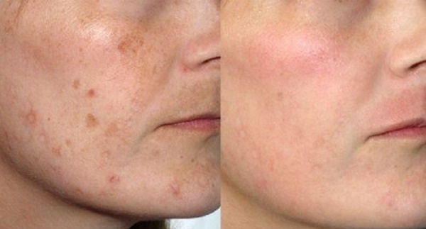 Penjagaan kulit setelah pengelupasan wajah: laser, kimia, buah, glikolik, perkakasan, retinol, Jessner, kuning, TCA, bodyag, asam salisilat