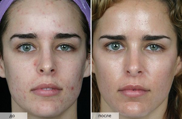 A top 10 professzionális ultrahangos készülék otthoni arcbőr tisztítására. Vélemények, fotók és eredmények